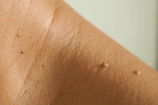 Skin Tags And Your Blood Sugar - nadaderm