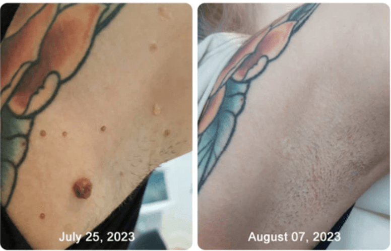 NadaDerm Elite + 1 FREE - nadaderm