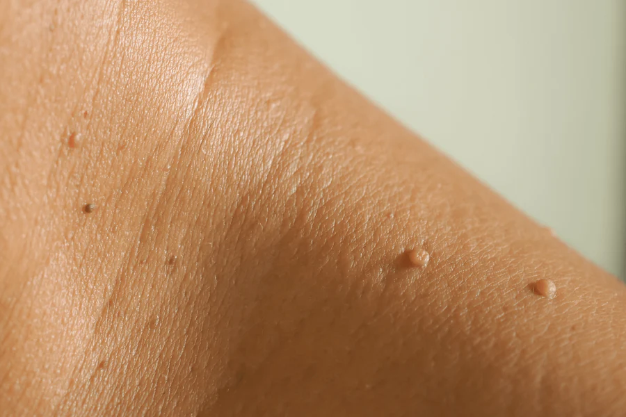 Skin Tags And Your Blood Sugar