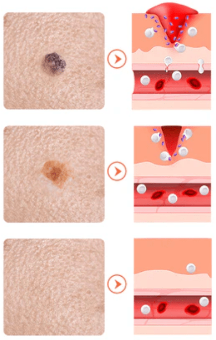 2x NadaDerm Elite BOGO - nadaderm