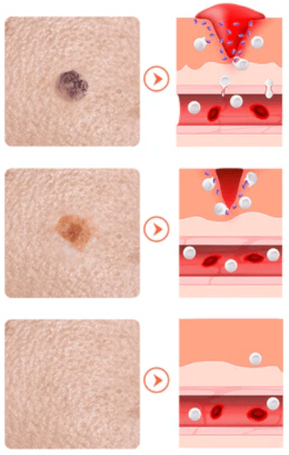 2x NadaDerm Elite BOGO - nadaderm