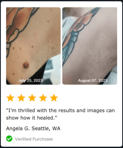 2x NadaDerm Elite BOGO - nadaderm