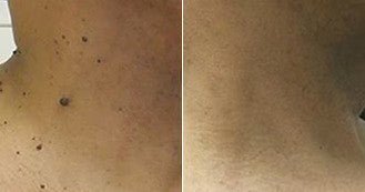 NadaDerm Elite® - nadaderm