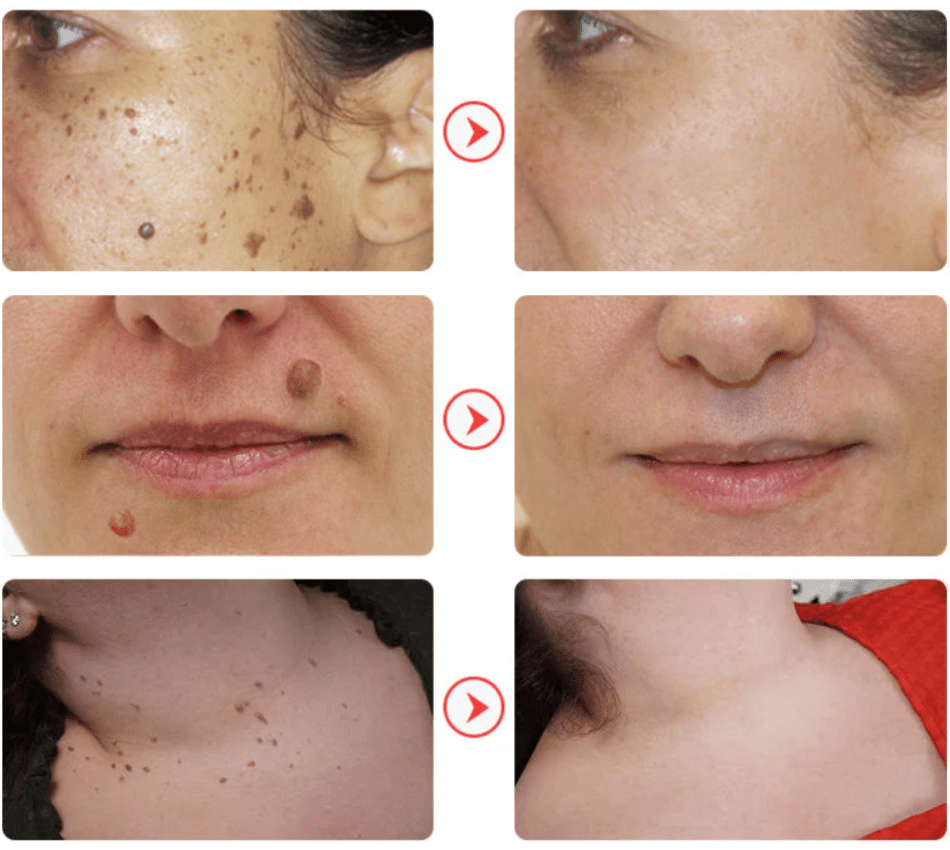 NadaDerm Elite® - nadaderm