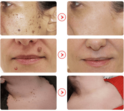 NadaDerm Elite® - nadaderm