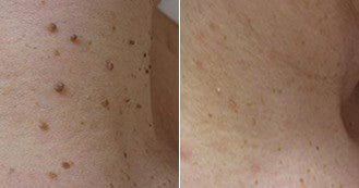 NadaDerm Elite® - nadaderm