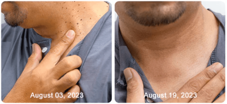 Original NadaDerm® - nadaderm