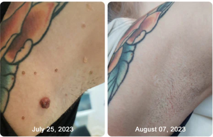 skin-tags-photo1.png__PID:43bb6459-f0bd-462a-bfe1-e01a9f112340